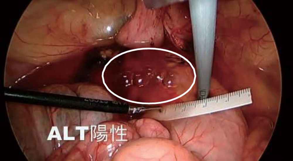 ネオレクタルプローブ