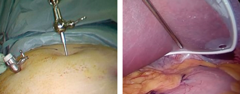 ホープL字型リバーリトラクター