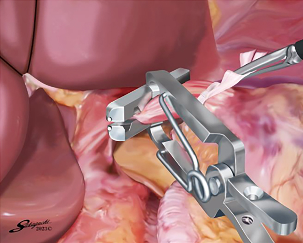 デタッチャブルENDO-PSI