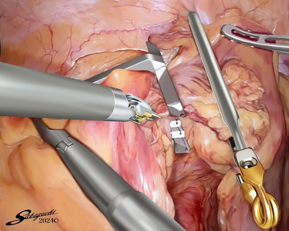 デタッチャブルENDO-PSI